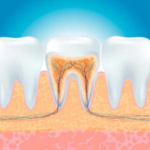 root canal abbotsford