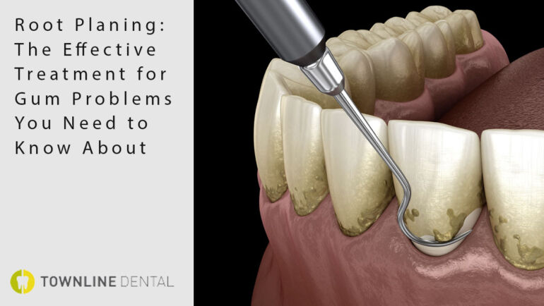 ‍Root Planing: The Effective Treatment for Gum Problems You Need to Know About