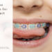When is the Right Time for Kids to Start Braces?