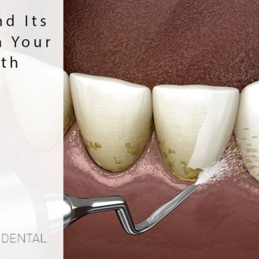 Plaque and Its Effects on Your Oral Health