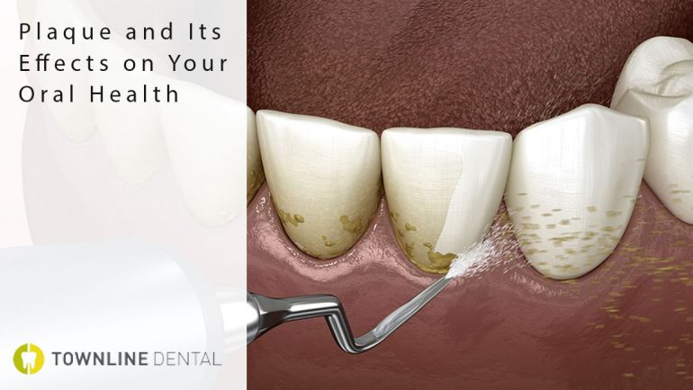 Plaque and Its Effects on Your Oral Health